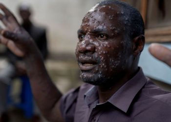 African Union Declares Public Health Emergency as Mpox Cases Surge