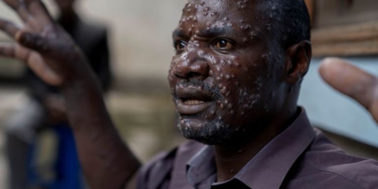 African Union Declares Public Health Emergency as Mpox Cases Surge