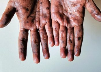 Goma Faces New Mpox Outbreak Amid Ongoing Conflict in Eastern Congo